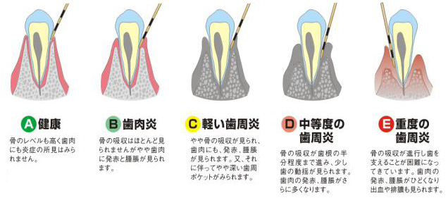 むし歯09.jpg