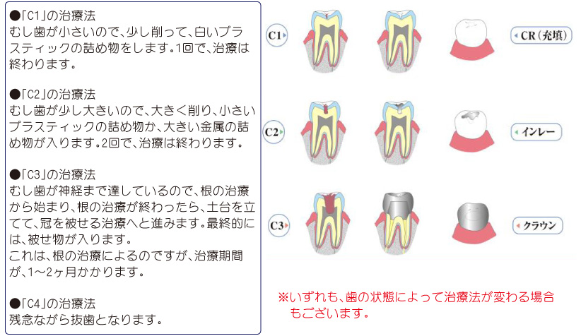 むし歯03.jpg