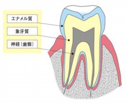 むし歯01.jpg