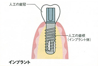 インプラントとは01.png