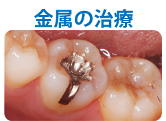 金属文字入り.png